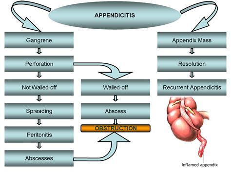 If not treated promptly, the appendix can rupture. . 4 stages of appendicitis